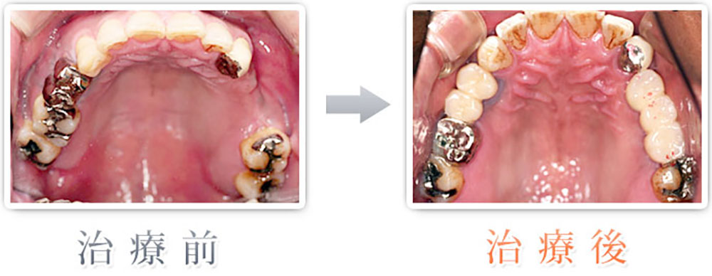 治療症例：右上奥歯3本をインプラント