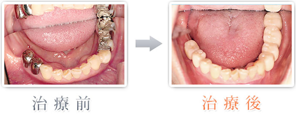 治療症例：銀歯をセラミックに、右下1本をインプラント