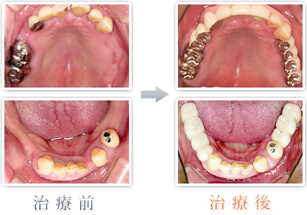 治療症例：上下奥歯の計8本をインプラント