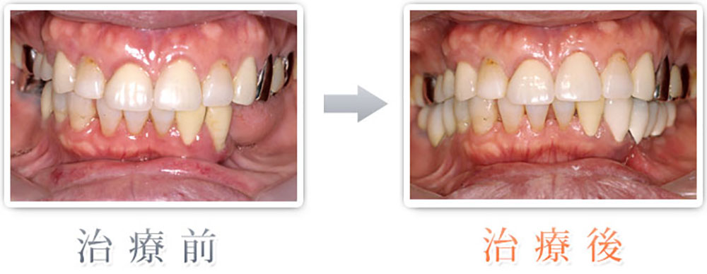 治療症例：左右3本づつの歯をインプラント
