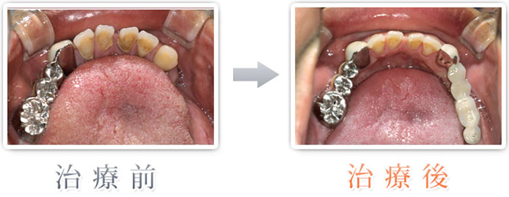 治療症例：左下奥歯3本をインプラント