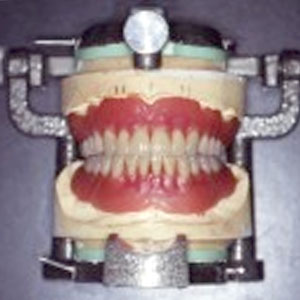 なかの歯科クリニック（岡山）で超精密入れ歯治療